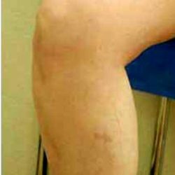 Varicose Spider Vein Removal Before & After Patient #1426