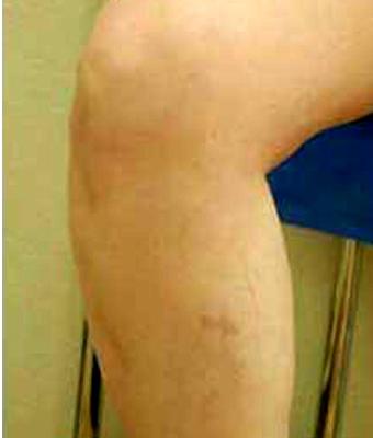 Varicose Spider Vein Removal Before & After Patient #1426