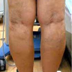 Varicose Spider Vein Removal Before & After Patient #1427