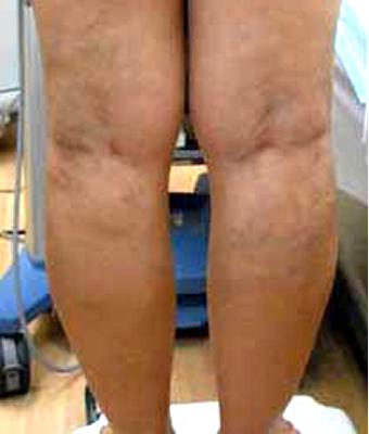 Varicose Spider Vein Removal Before & After Patient #1427