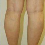 Varicose Spider Vein Removal Before & After Patient #1427