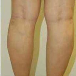 Varicose Spider Vein Removal Before & After Patient #1427