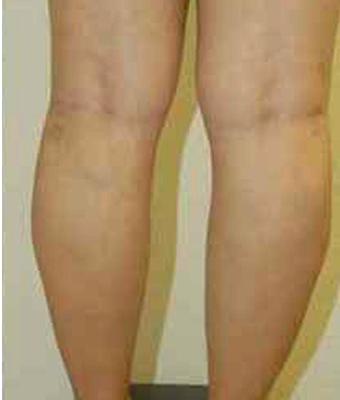 Varicose Spider Vein Removal Before & After Patient #1427