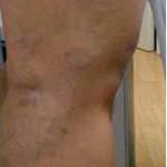 Varicose Spider Vein Removal Before & After Patient #1428
