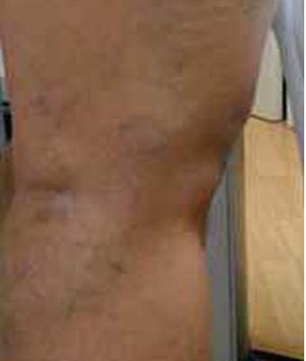 Varicose Spider Vein Removal Before & After Patient #1428