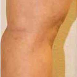 Varicose Spider Vein Removal Before & After Patient #1428