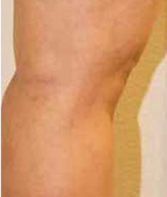Varicose Spider Vein Removal Before & After Patient #1428