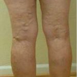 Varicose Spider Vein Removal Before & After Patient #1429