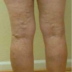 Varicose Spider Vein Removal Before & After Patient #1429