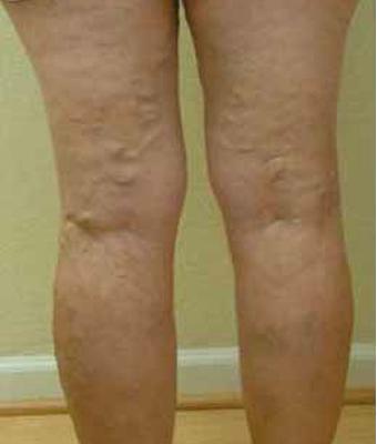 Varicose Spider Vein Removal Before & After Patient #1429