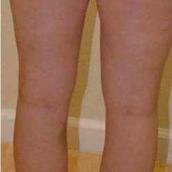 Varicose Spider Vein Removal Before & After Patient #1429