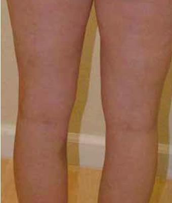 Varicose Spider Vein Removal Before & After Patient #1429