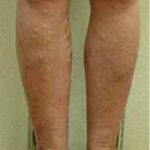 Varicose Spider Vein Removal Before & After Patient #1430