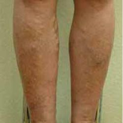 Varicose Spider Vein Removal Before & After Patient #1430