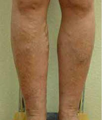 Varicose Spider Vein Removal Before & After Patient #1430