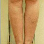 Varicose Spider Vein Removal Before & After Patient #1430