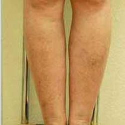 Varicose Spider Vein Removal Before & After Patient #1430