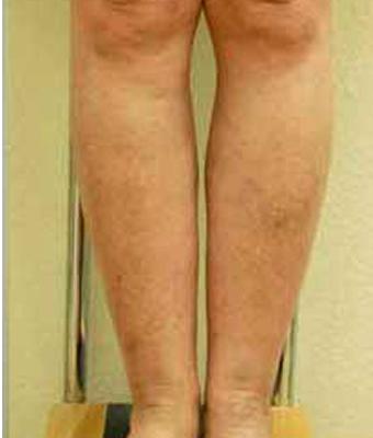 Varicose Spider Vein Removal Before & After Patient #1430