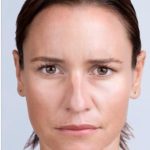 Xeomin Before & After Patient #1538