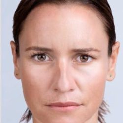 Xeomin Before & After Patient #1538