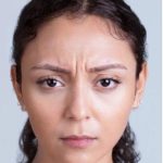 Xeomin Before & After Patient #1539