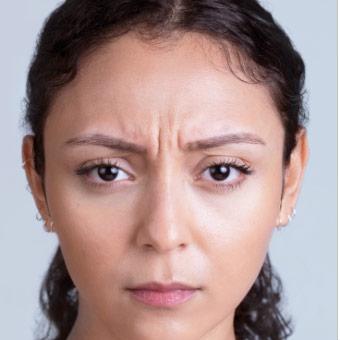 Xeomin Before & After Patient #1539
