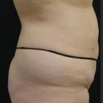 Mommy Makeover Before & After Patient #1951
