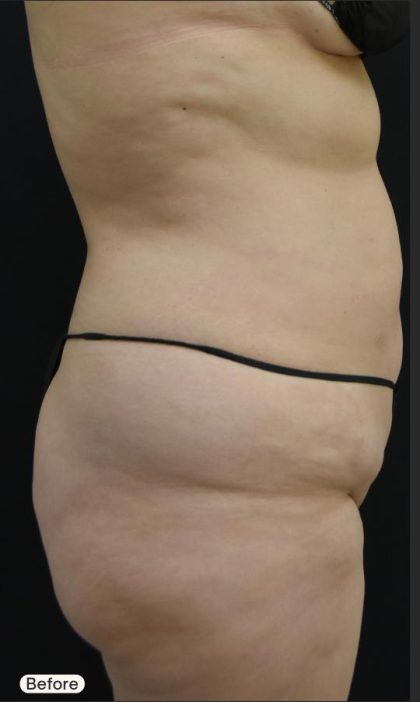 Mommy Makeover Before & After Patient #1951